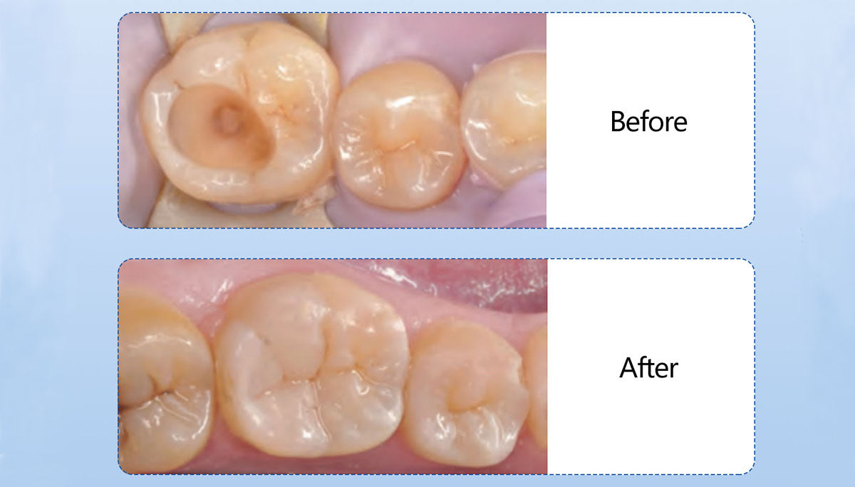 The Steps Of Composite Fillings