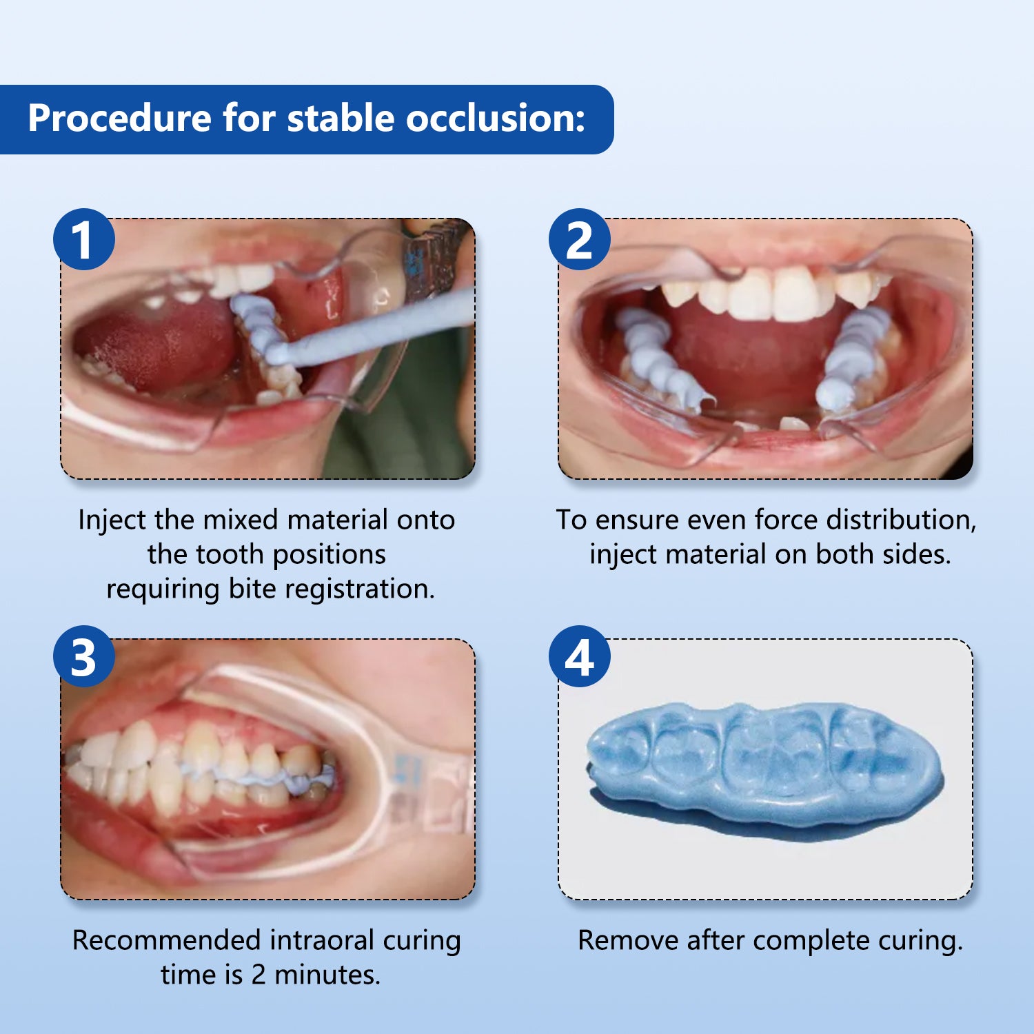Dental Bite Registration Material Fast Set 2 Cartridges Of 50ML Mixing Tips