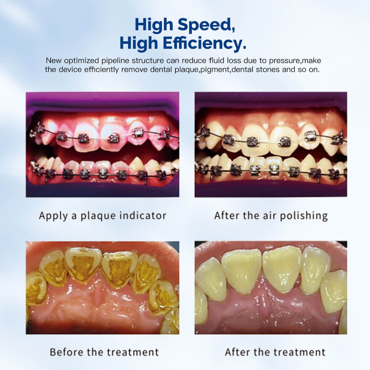 Dental VRN-DQ40 Ultrasonic Scaler Air Polisher Sandblasting Periodontal Therapy System LED Handpiece - azdentall.com