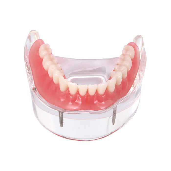Dental Implant Teeth Model Demo Overdenture Restoration With 2 Implants Lower - azdentall.com