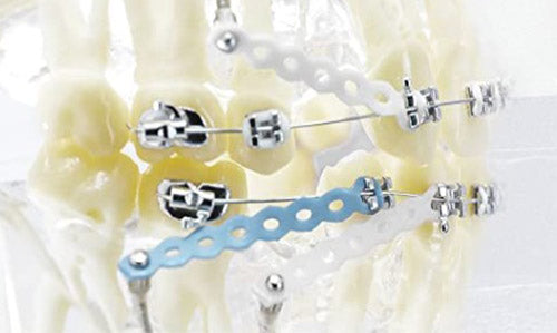 Orthodontic Guides
