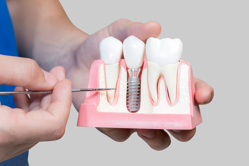 Q&A of Dental Implant Products - azdentall.com
