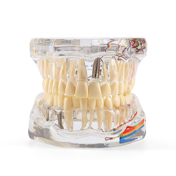 Dental Oral Typodont Model Implant Pathological Removable Teach Demo Transparent - azdentall.com