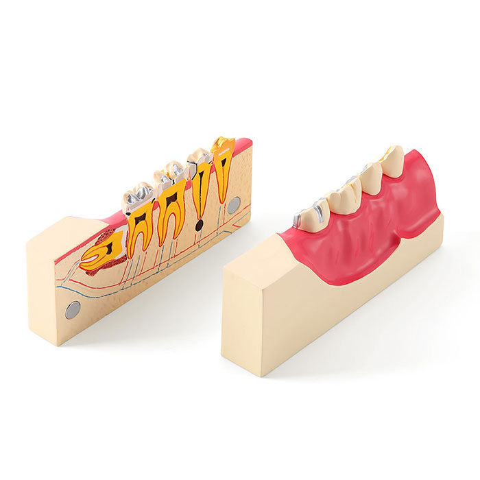 Dental Teaching Model Tissue Decomposition Model Right Lower Posterior - azdentall.com