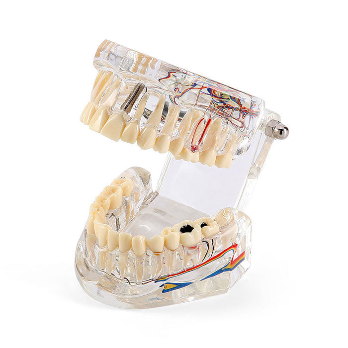 Dental Orthodontic Typodont Model - Implant & Denture Restoration Practice Model 2 thumbnail image