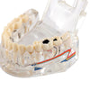 Dental Oral Typodont Model Implant Pathological Removable Teach Demo Transparent - azdentall.com