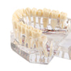 Dental Oral Typodont Model Implant Pathological Removable Teach Demo Transparent - azdentall.com