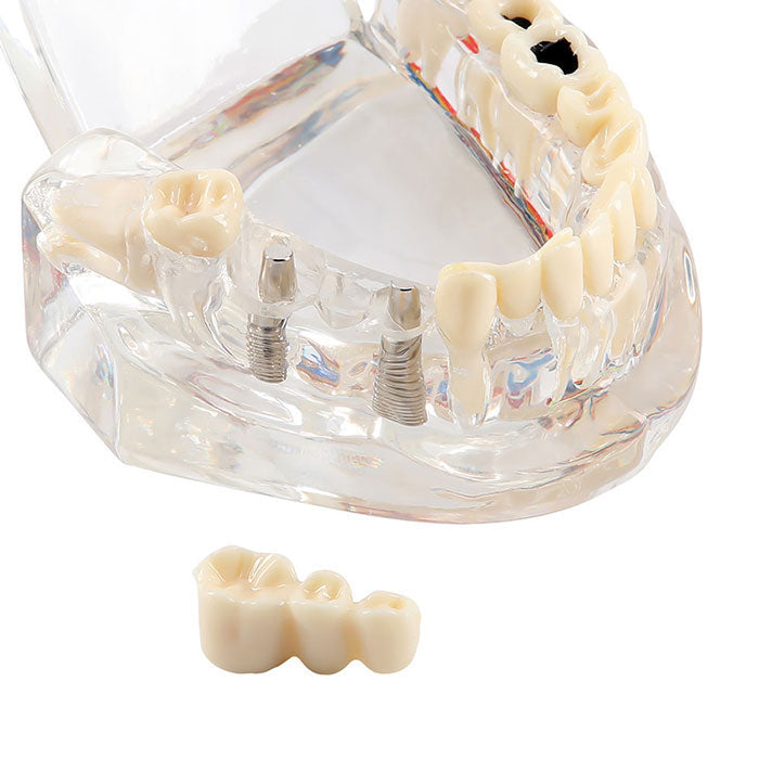 Dental Oral Typodont Model Implant Pathological Removable Teach Demo Transparent - azdentall.com