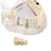 Dental Oral Typodont Model Implant Pathological Removable Teach Demo Transparent - azdentall.com