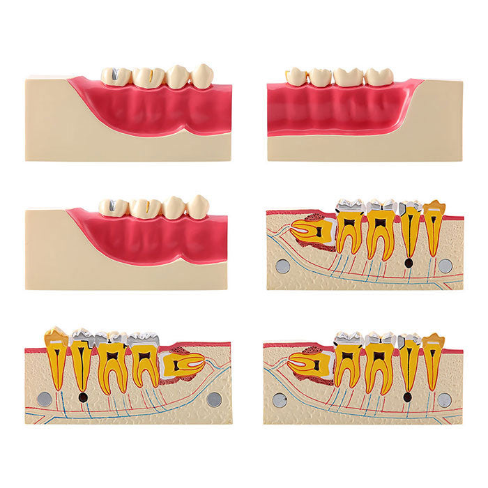 Dental Teaching Model Tissue Decomposition Model Right Lower Posterior - azdentall.com