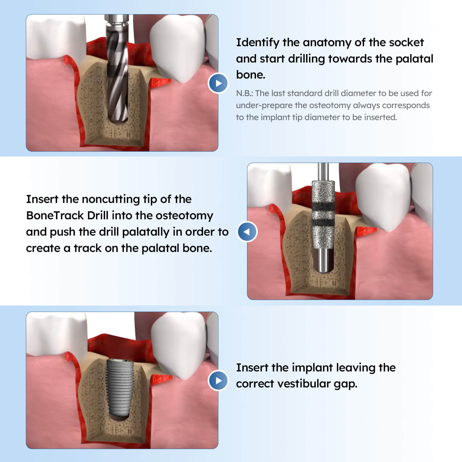 Dental Bone Track Drill Kit FG7604 Implant Insertion Position