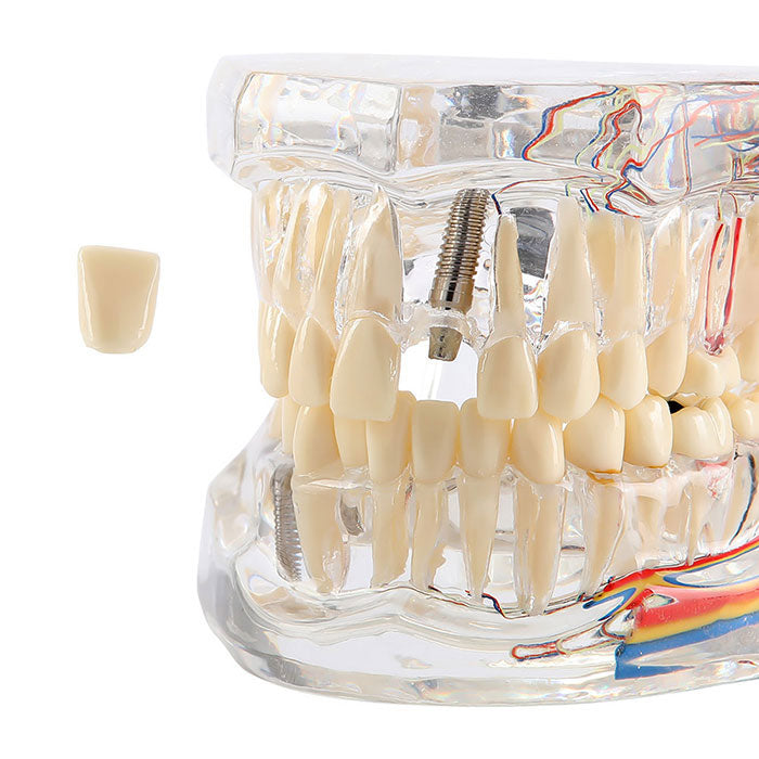 Dental Oral Typodont Model Implant Pathological Removable Teach Demo Transparent - azdentall.com