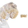 Dental Oral Typodont Model Implant Pathological Removable Teach Demo Transparent - azdentall.com