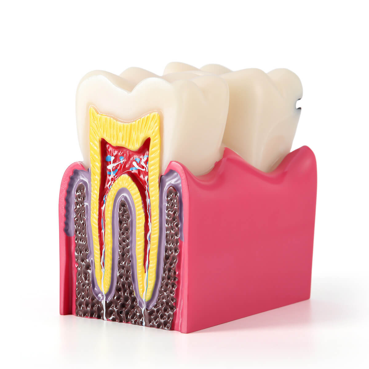 Dental Caries Tooth Model 6 Times Decay Teeth Comparative Study Model - azdentall.com