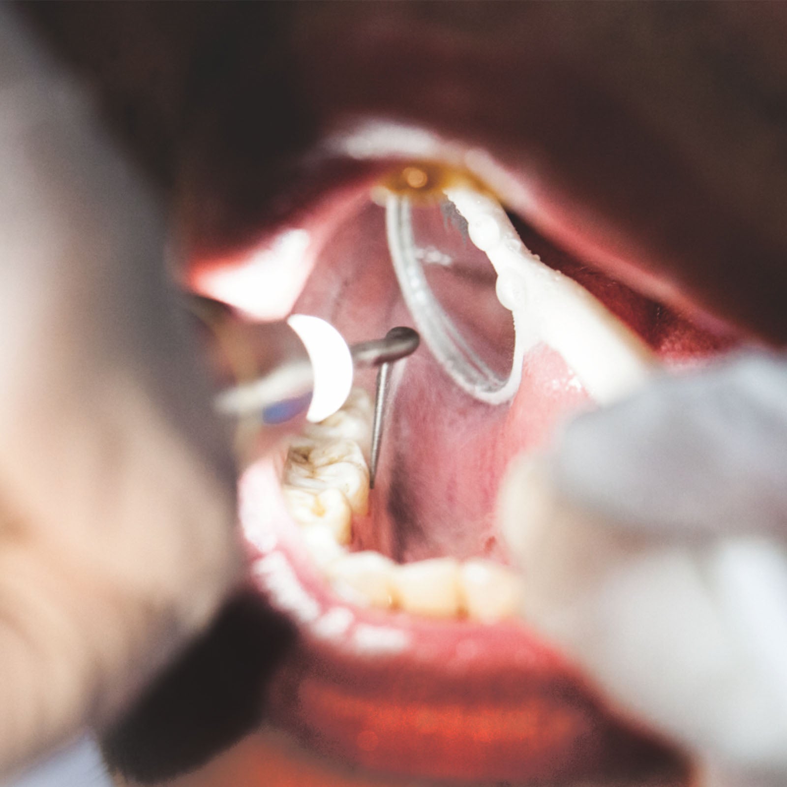 WOODPECKE PT3 Dental Periodontal Treatment Device Auto Water Supply System - azdentall.com