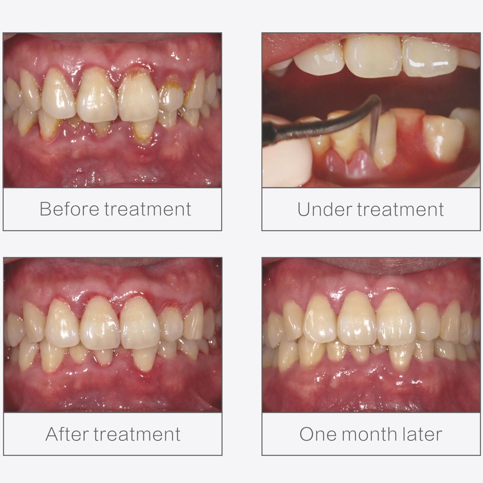 WOODPECKE PT3 Dental Periodontal Treatment Device Auto Water Supply System - azdentall.com
