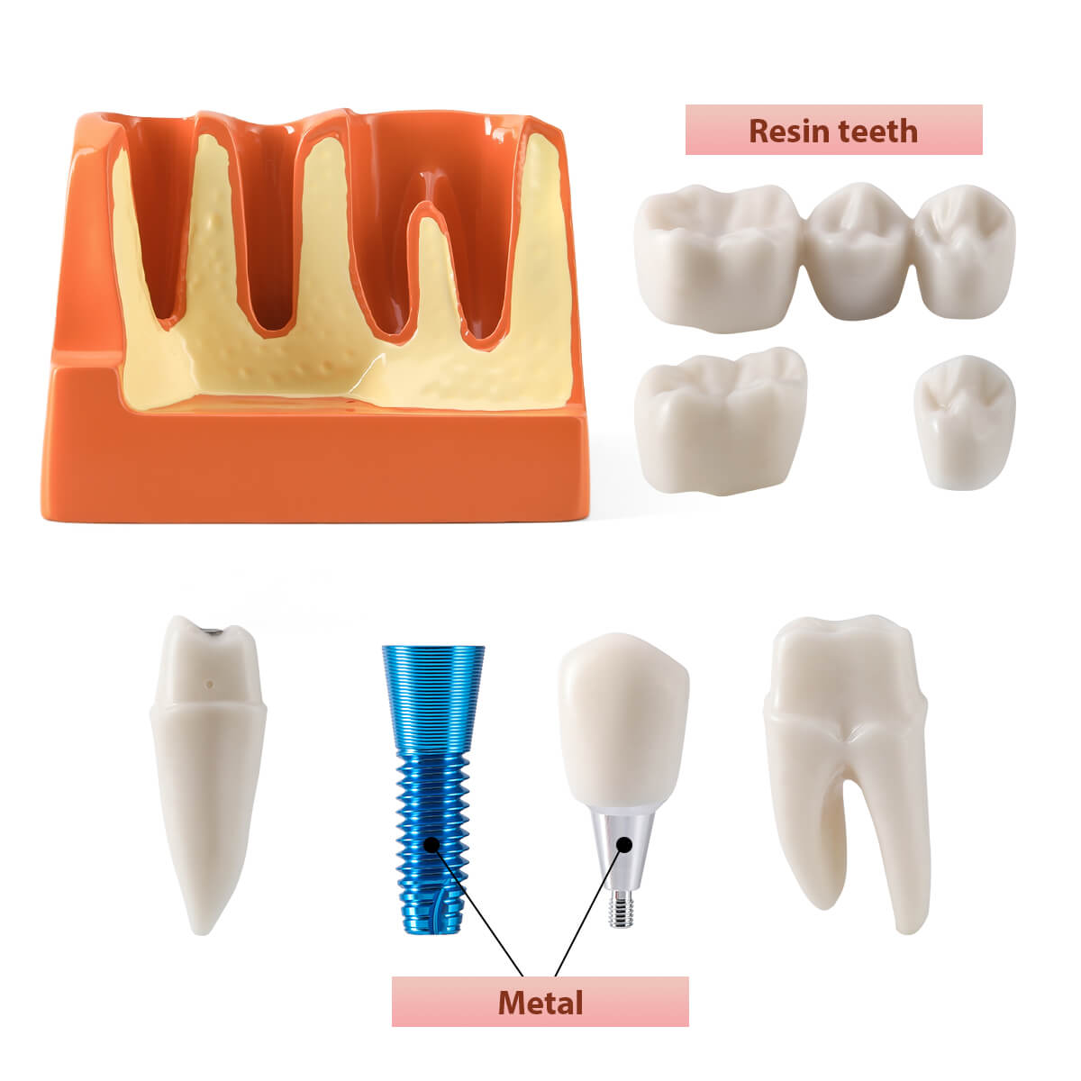 Dental Implant Crown Bridge Demonstration Study Model - Removable Teeth