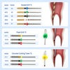 Dental Root Canal Broken File Extractor Endo Broken Files Removal System Instrument Set - azdentall.com