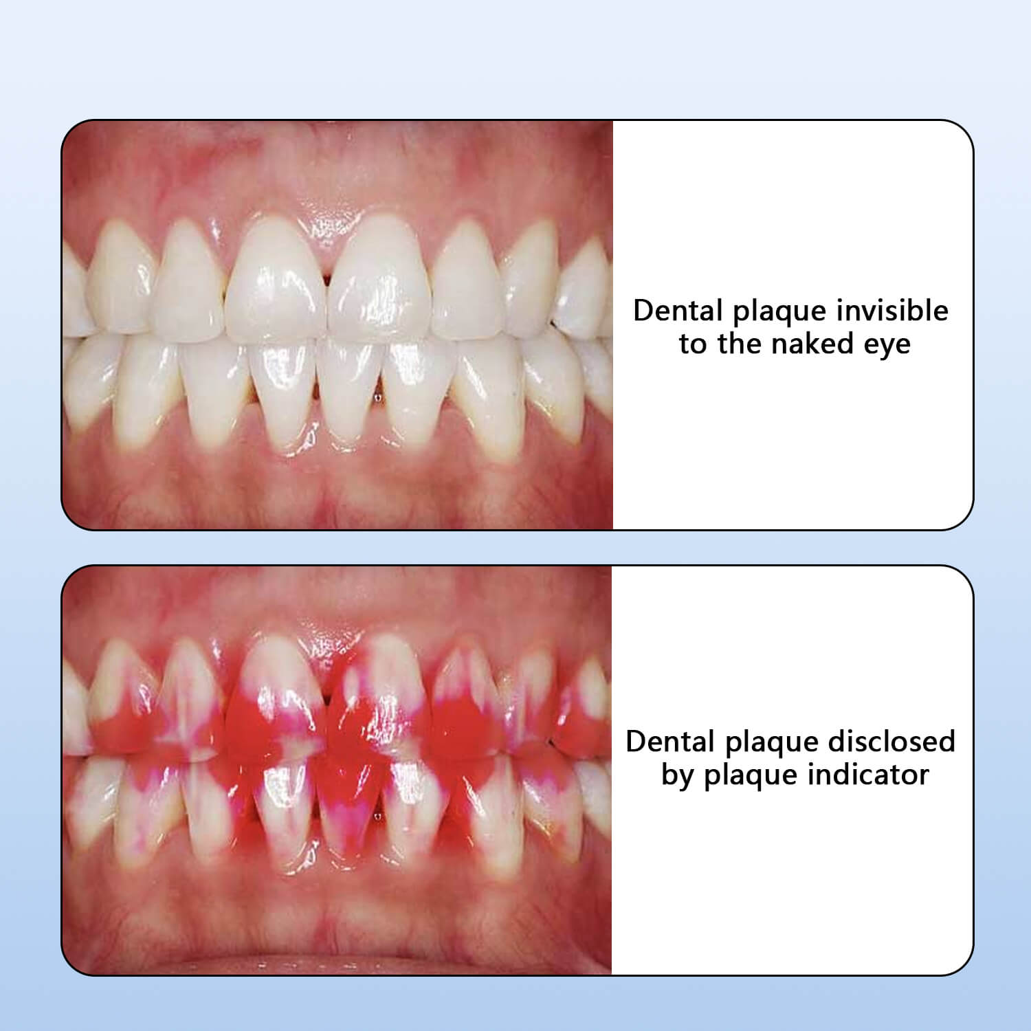Dental Plaque Disclosing Agent Oral Tartar Test Examination Plaque Indicator 5ml - azdentall.com