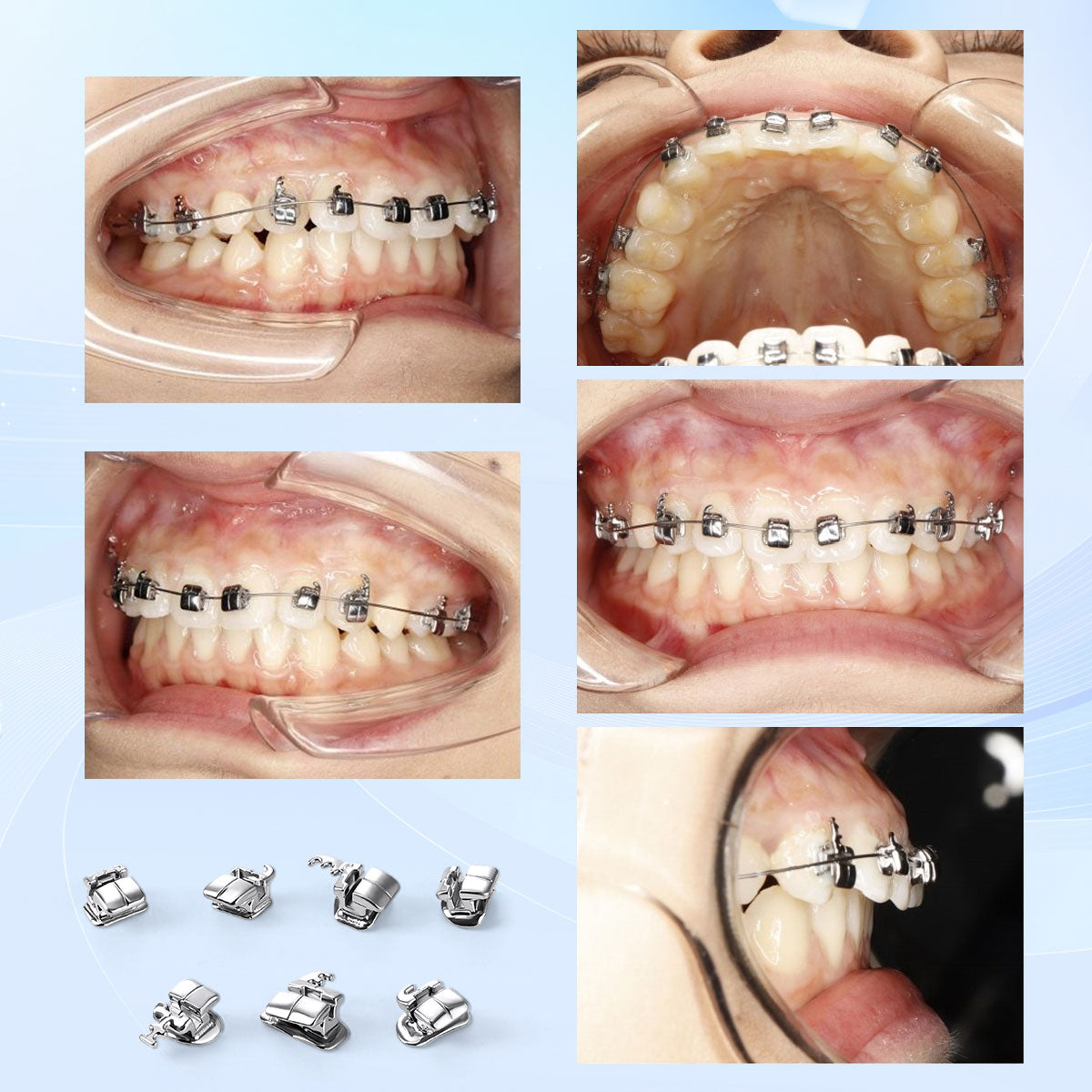 AZDENT Dental Metal Self-Ligating Brackets Multiple Hooks Roth/MBT .022 28pcs/Box - azdentall.com