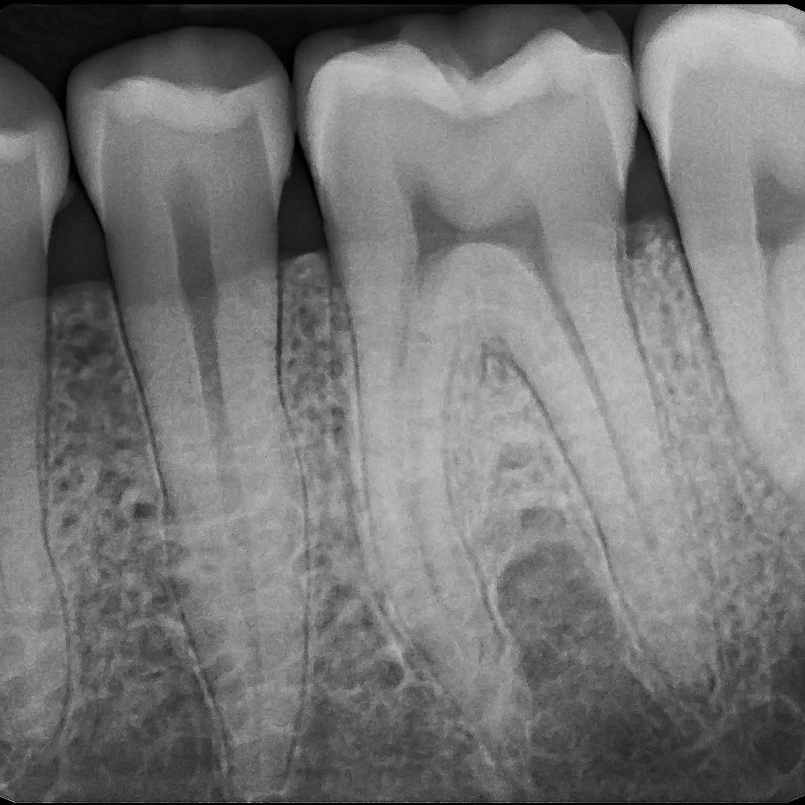 SOTA Imaging Clio Prime HD Intraoral Digital X-Ray Sensor - azdentall.com