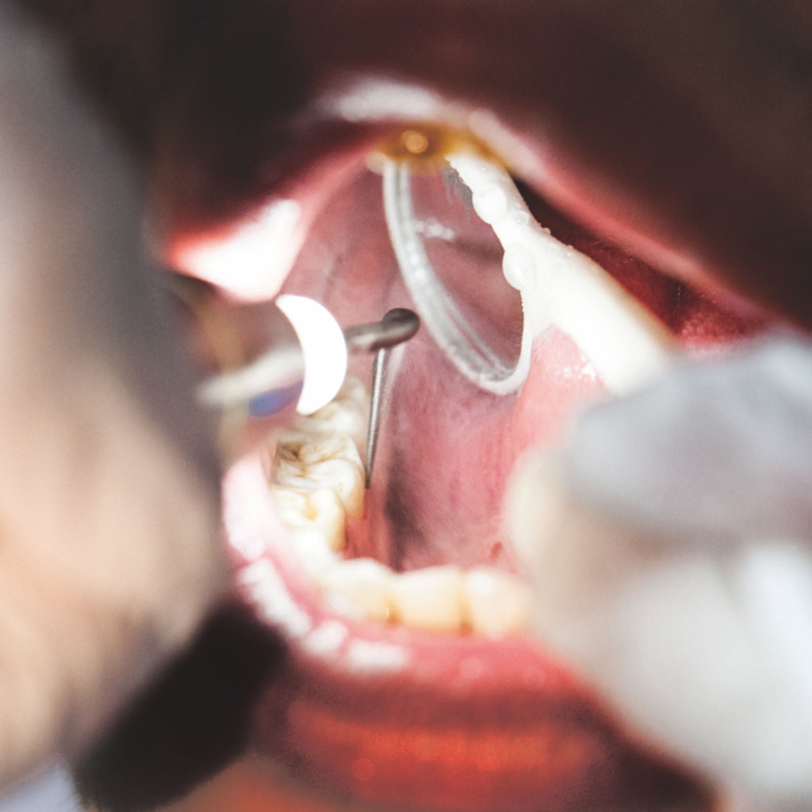 Woodpecker PT5 Endo Periodontal Treatment Device Auto Water Supply System - azdentall.com