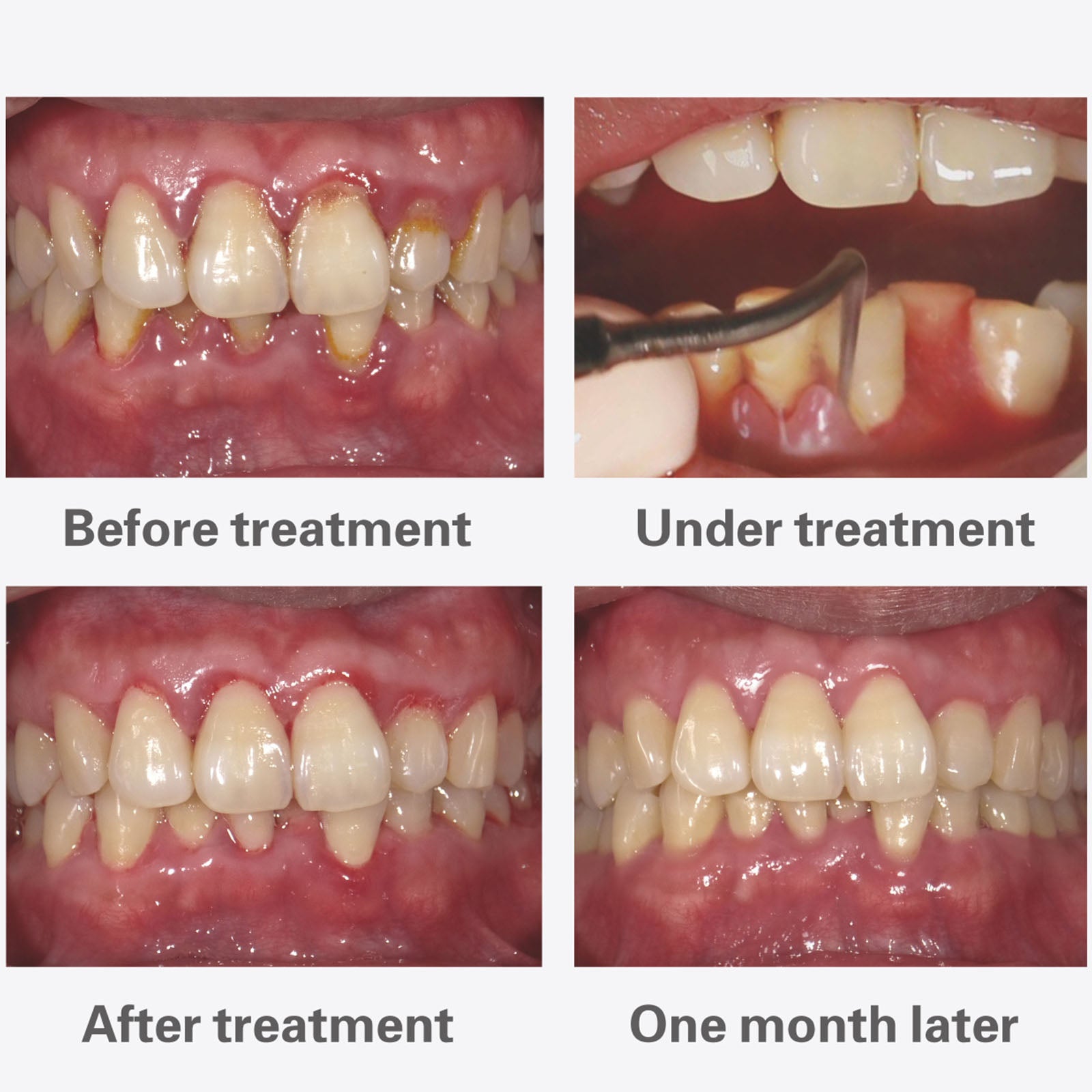 Woodpecker PT5 Endo Periodontal Treatment Device Auto Water Supply System - azdentall.com