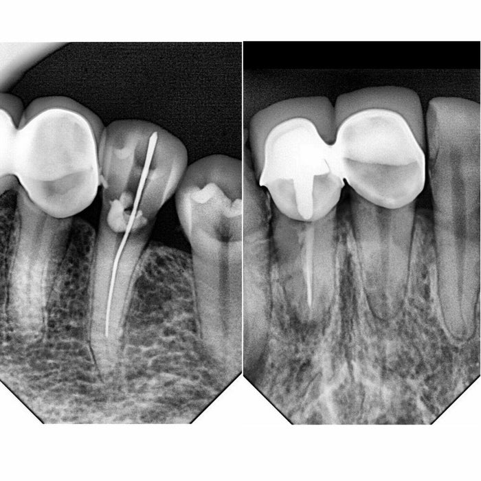 iRay Dental X-Ray Digital Intra-oral Sensor CMOS Detector Technology High Resolution Pluto 0015X - azdentall.com