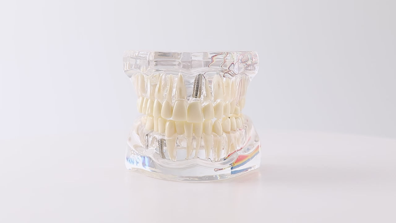 Load video: Dental Oral Typodont Model Implant Pathological Removable Teach Demo Transparent - azdentall.com