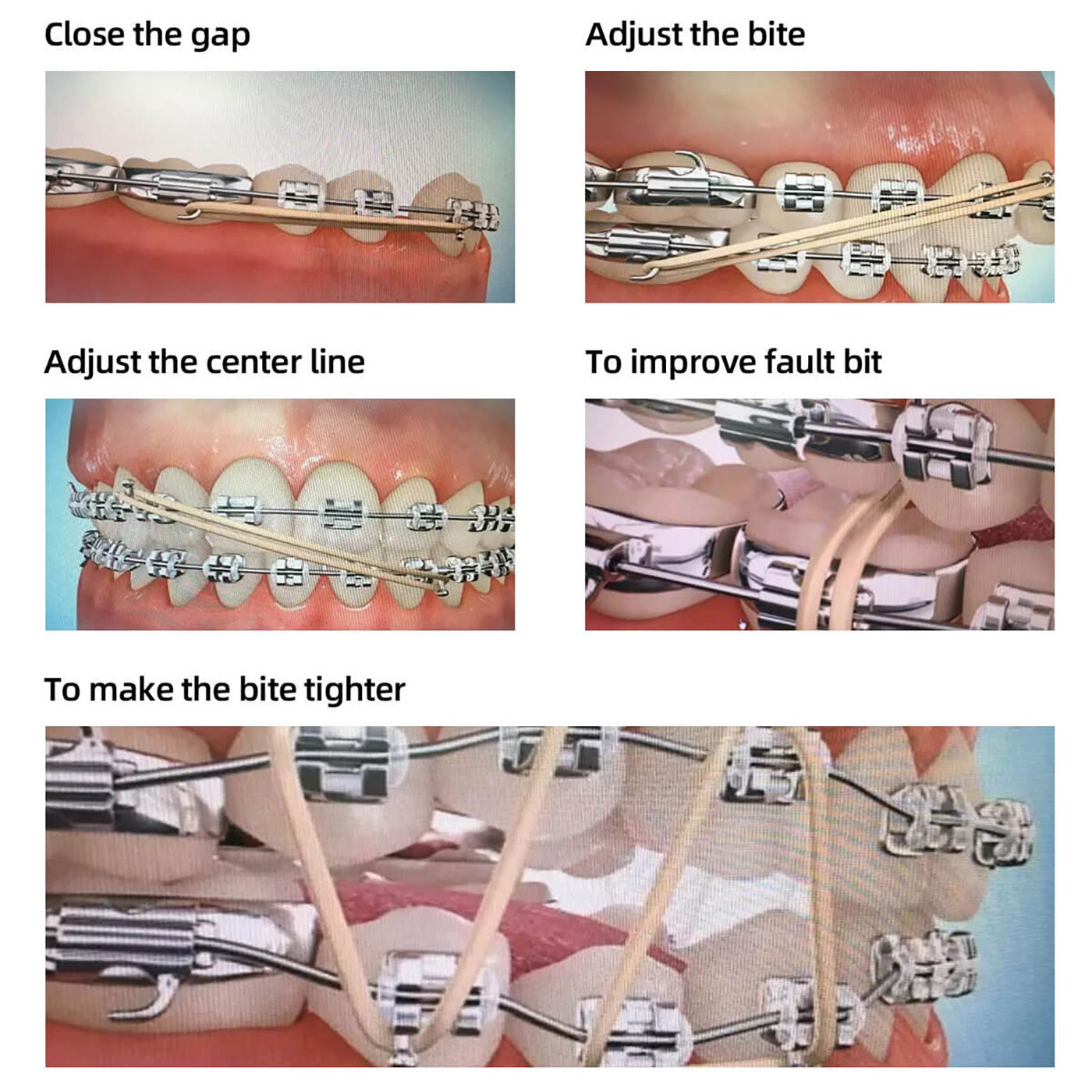 Pengpengfang Dental Orthodontic Rubber Bands Ortho Elastics Latex Braces  Non-toxic Tool 