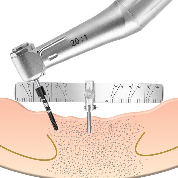 Positioning Implant Instruments Dental Implant Locating Guide Planting Positioning Locator Angle Ruler ...