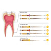 AZDENT Dental NiTi Rotary Engine Files 25mm Assorted SX-F3 Gold Taper 6pcs/Pk - azdentall.com