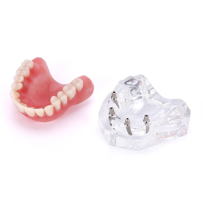 Dental Implant Teeth Model Demo Overdenture Restoration With Implants Upper