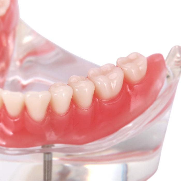 Dental Implant Teeth Model Demo Overdenture Restoration With 2 Implants Lower - azdentall.com