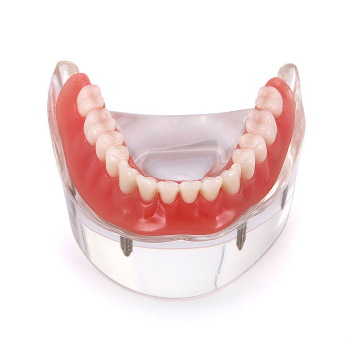 Dental Implant Teeth Model Demo Overdenture Restoration With 4 Implants Lower - azdentall.com