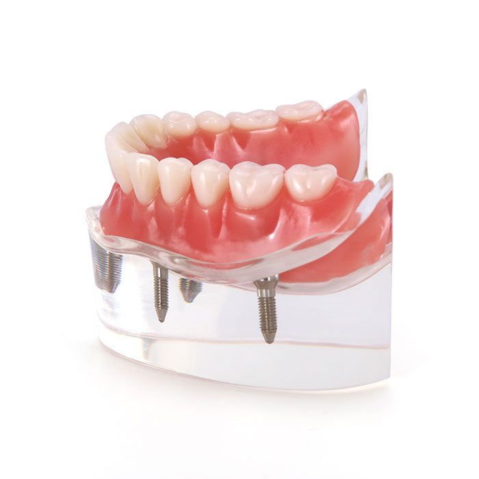Dental Implant Teeth Model Demo Overdenture Restoration With 4 Implants Lower - azdentall.com