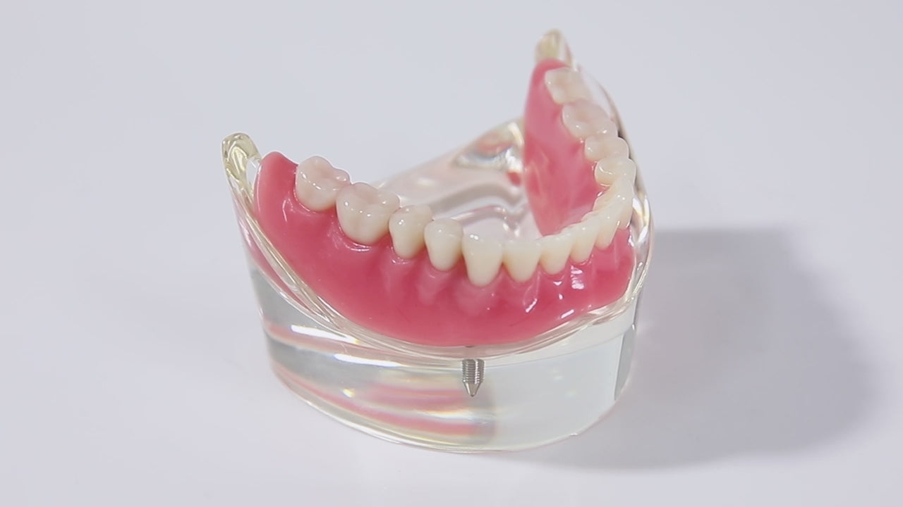 Load video: Dental Implant Teeth Model Demo Overdenture Restoration With 2 Implants Lower - azdentall.com
